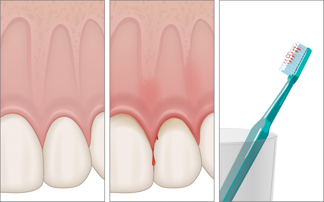 Was ist die Gingivitis und wie häufig kommt sie vor?